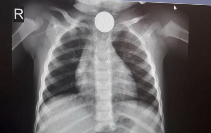 חתיכת פלסטיק ממשחק נשלפה מקיבת פעוט