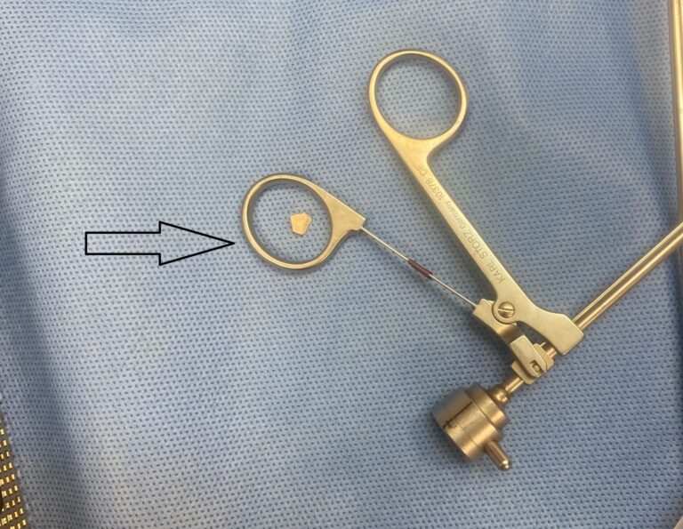 הרופאים הוציאו אבן מריאותיה של פעוטה בת שנה